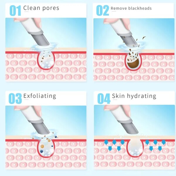 Aqua Peeling Ansiktsrenser – Hydra Dermabrasjon & Oksygen