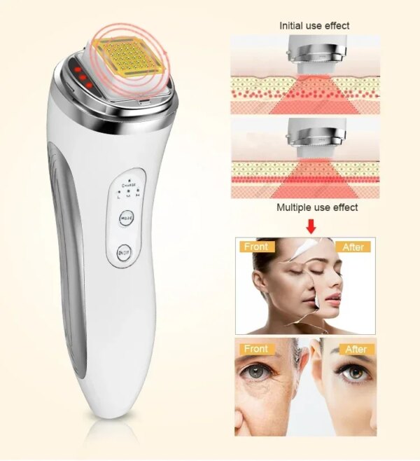 RF face lifting device for skin tightening and wrinkle reduction